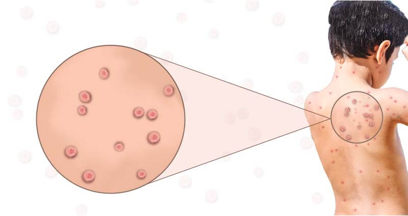 Moluscocontagioso