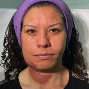 Maquillaje de Camuflaje Estético