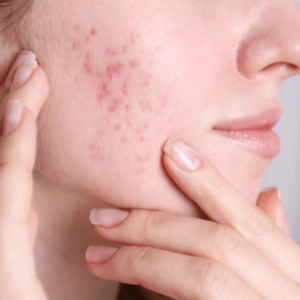 Pack Acné Comedogénico