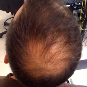 Pack Alopecia
