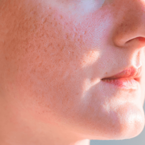 Pack Cicatrices Atróficas