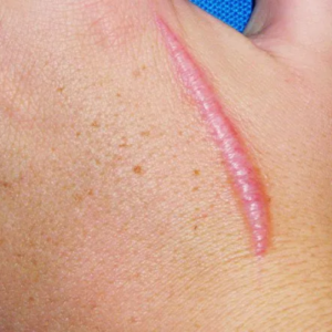 Pack Cicatrices Hipertróficas