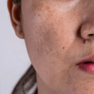 Pack Hiperpigmentación