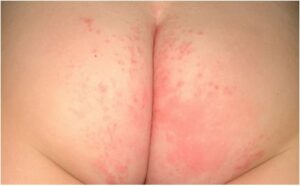 severe diaper rash picture